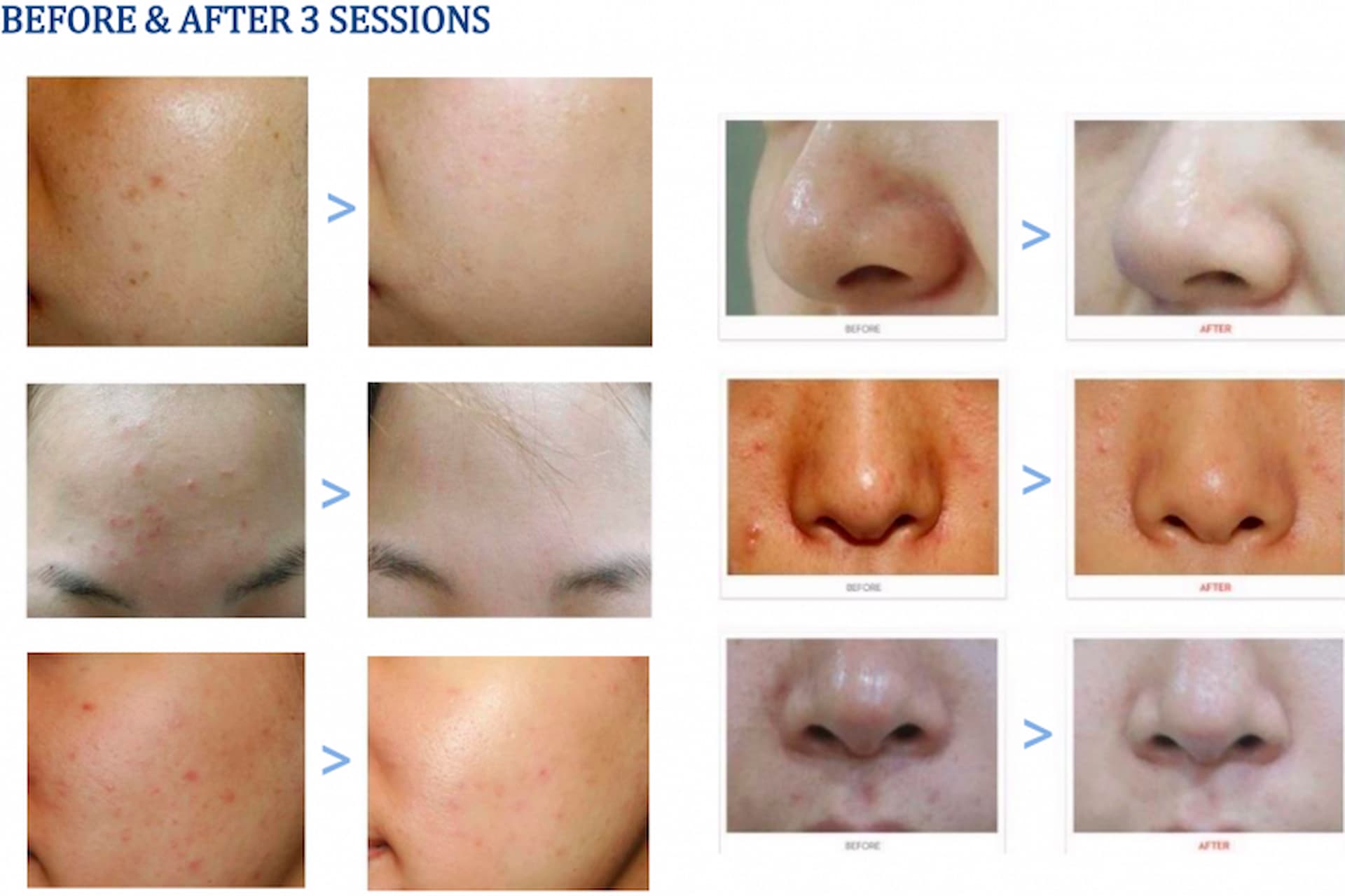 hydrafacial-7
