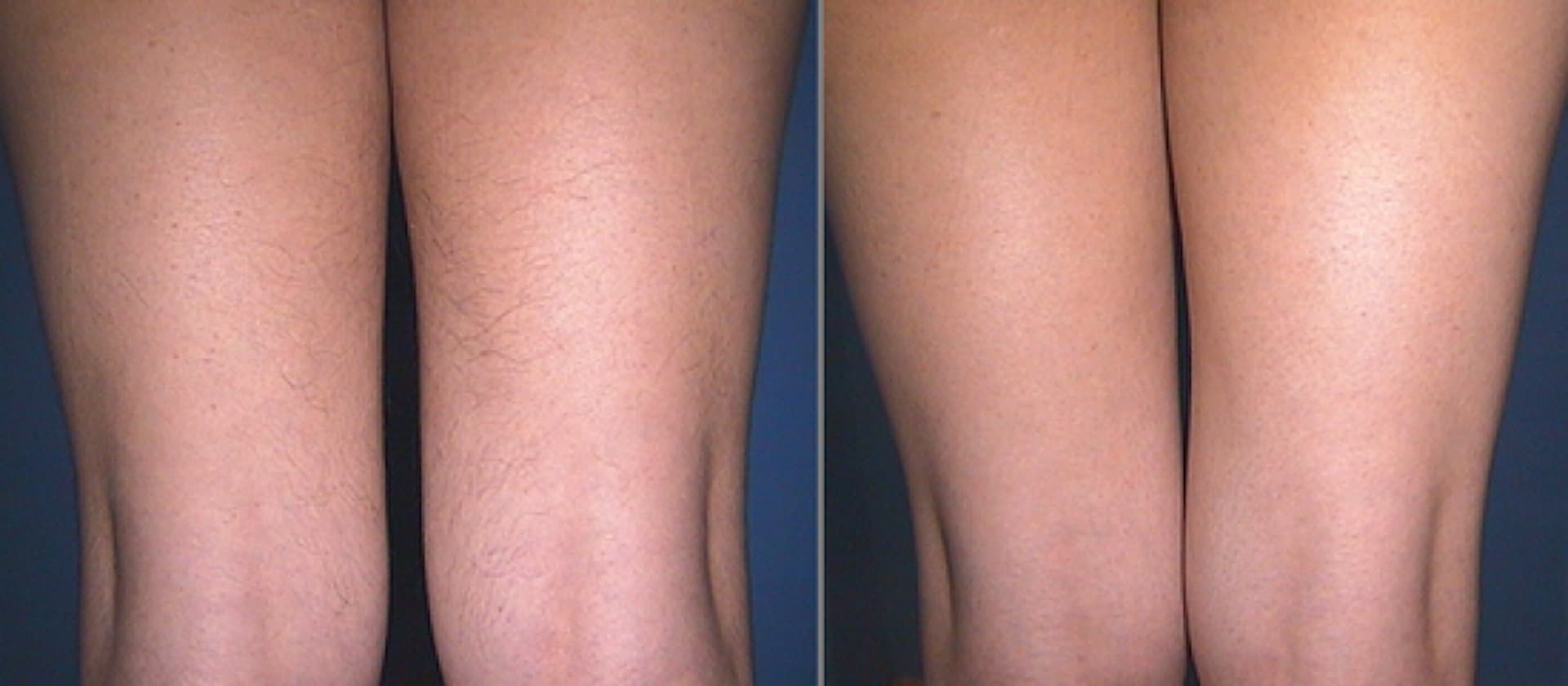 laser-hair-removal-1