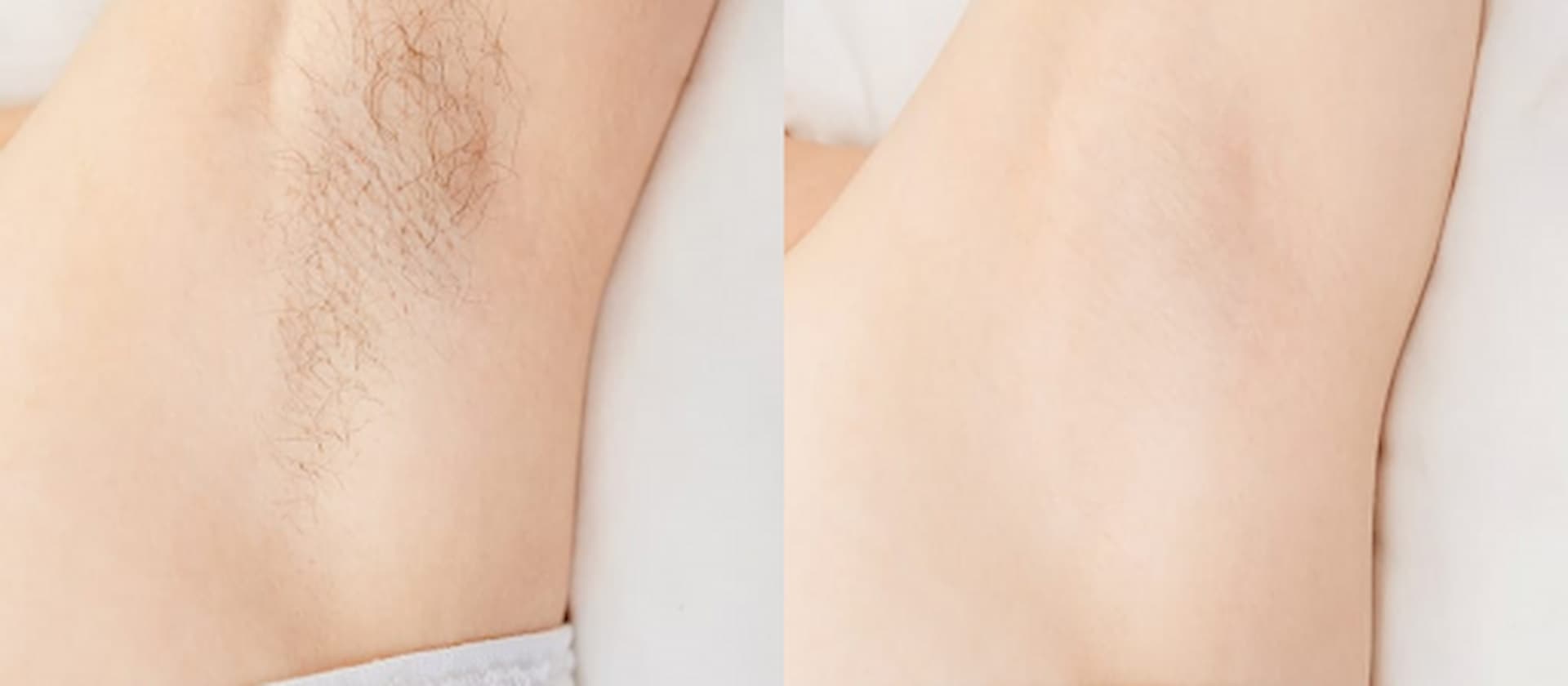 laser-hair-removal-2
