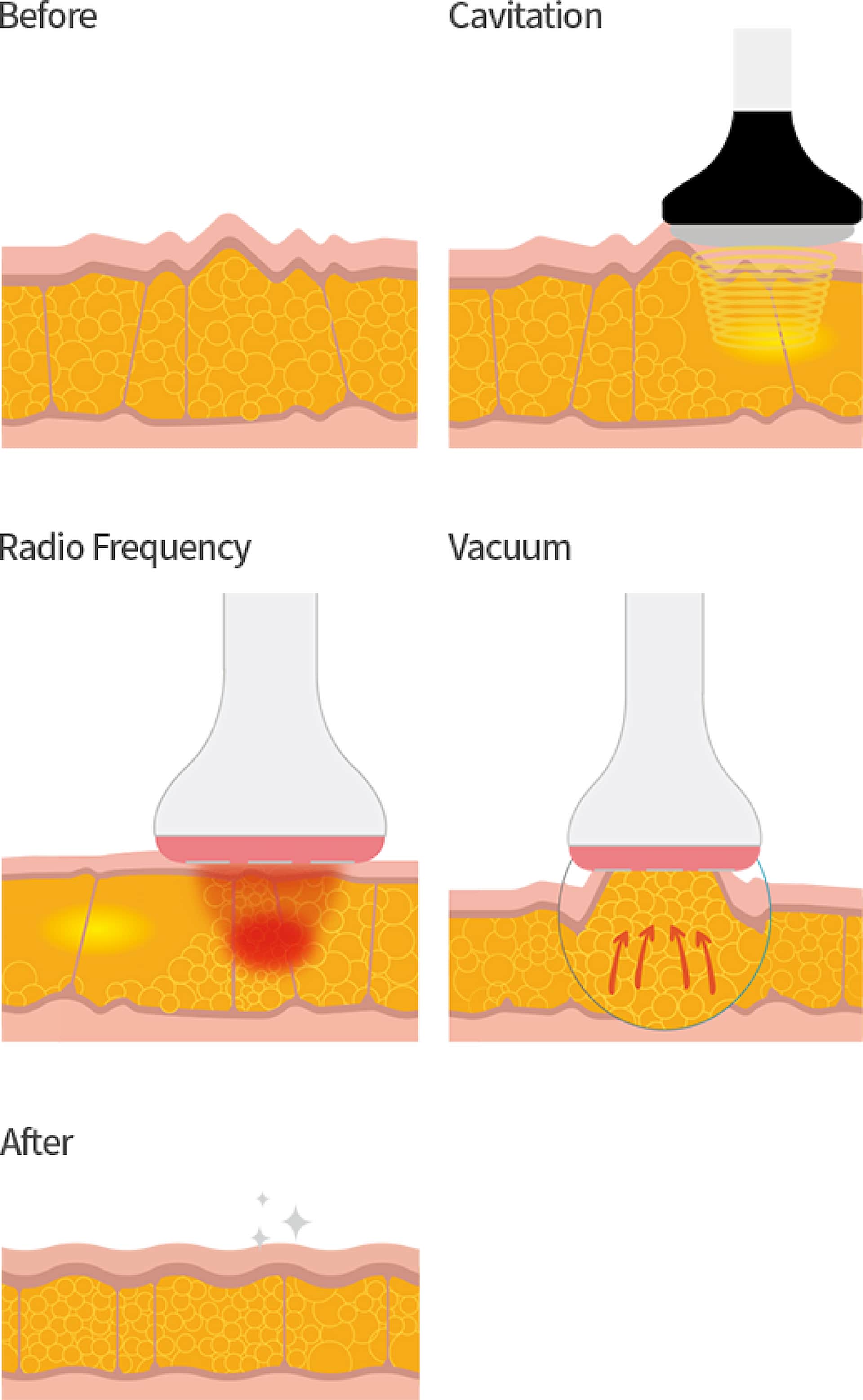 lipo-x-face-contouring-3
