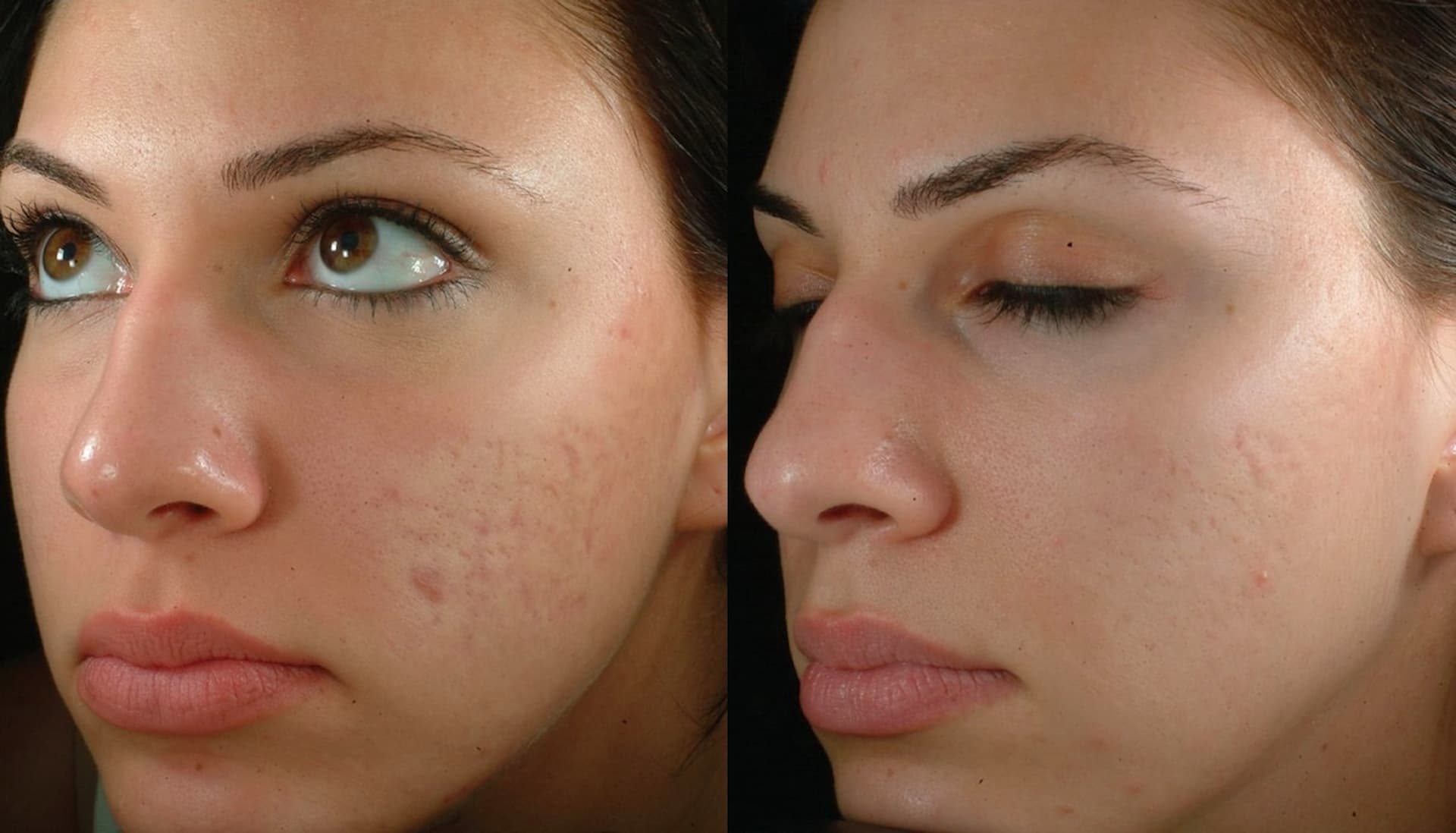 raffine-microneedling-1