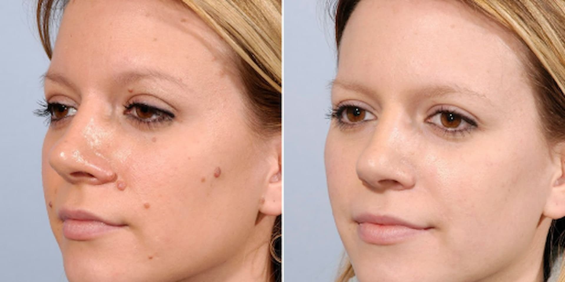 warts-and-verruca-removal-1