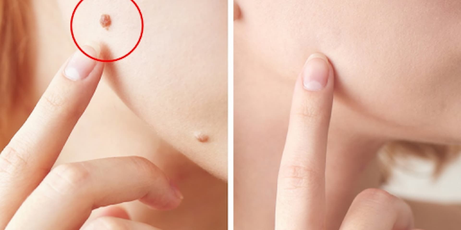 warts-and-verruca-removal-2